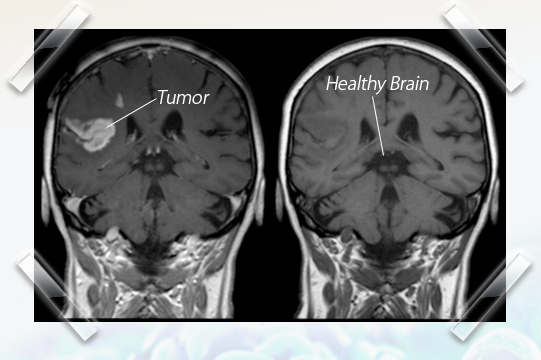 Meridian Health Protocol - Healthy brain vs Tumor picture