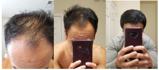 A man's before and after hair growth picture after using of the Trichofol.